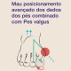 Meia Corretora de Joanetes e Pés Valgus Tape Sox Hallux Valgus +Plus - Correção Forte